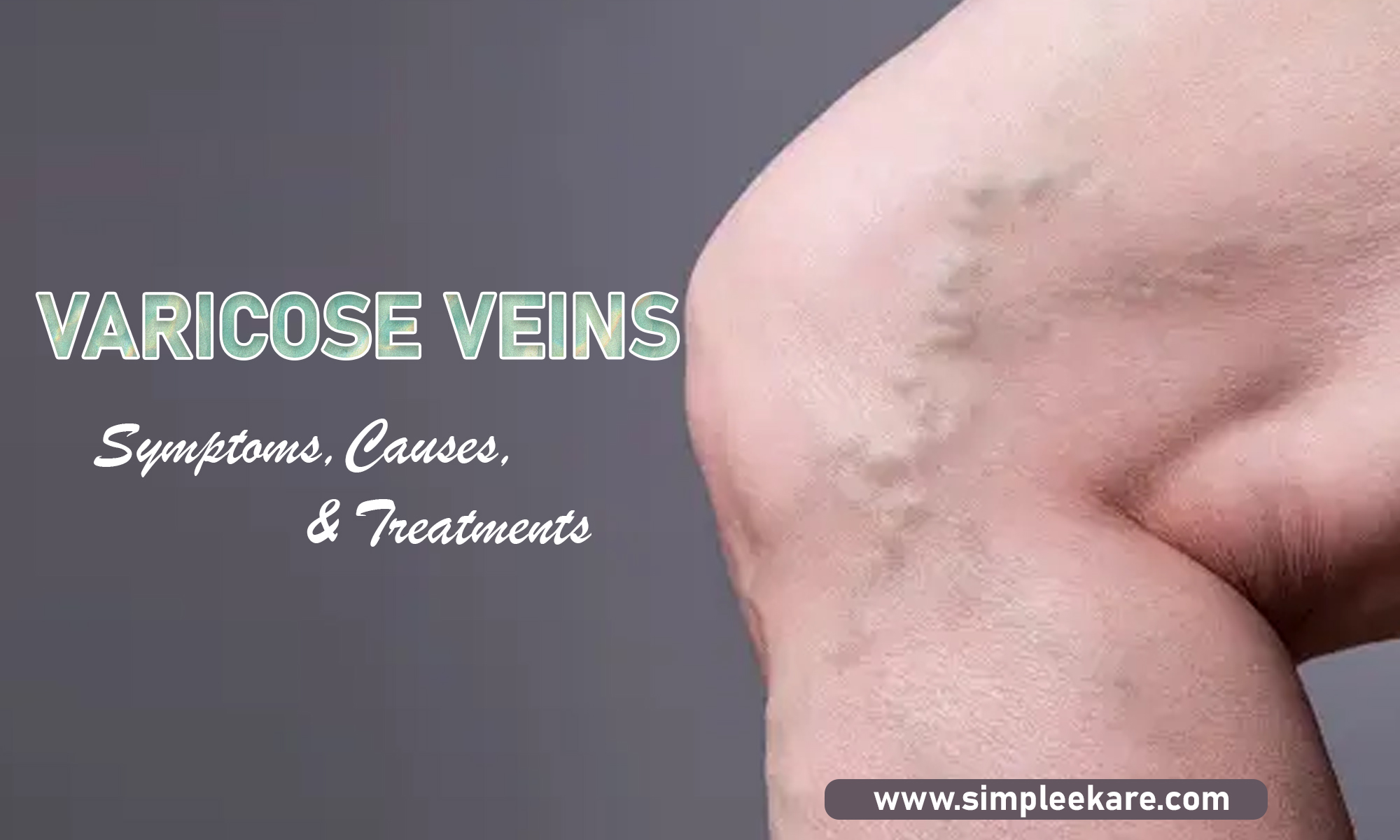 Varicose Veins: Symptoms, Causes, Complications, and Effective Treatment