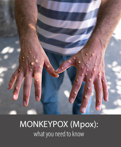 Monkeypox outbreak