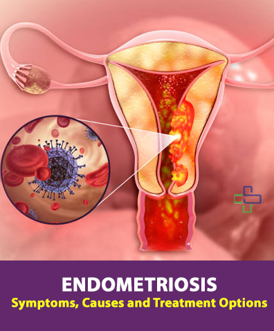 Endometriosis Surgery in Bhubaneswar - SimpleeKare hospital