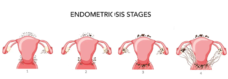 Endometriosis surgery in bhubaneswar