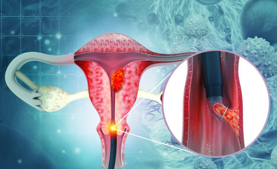 Endometriosis treatment in bhubameswar