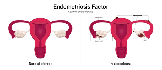 Endometriosis surgery -causes of infertiliy