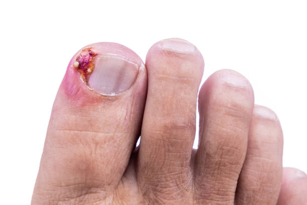 Ingrown toenail removal surgery
