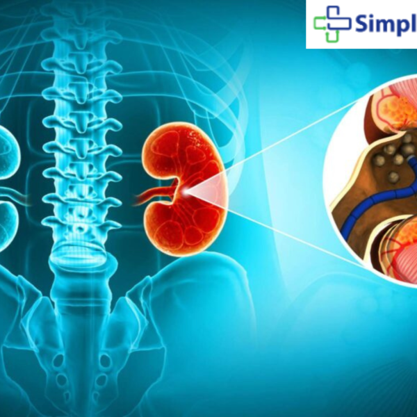 kidney stone laser surgery near me