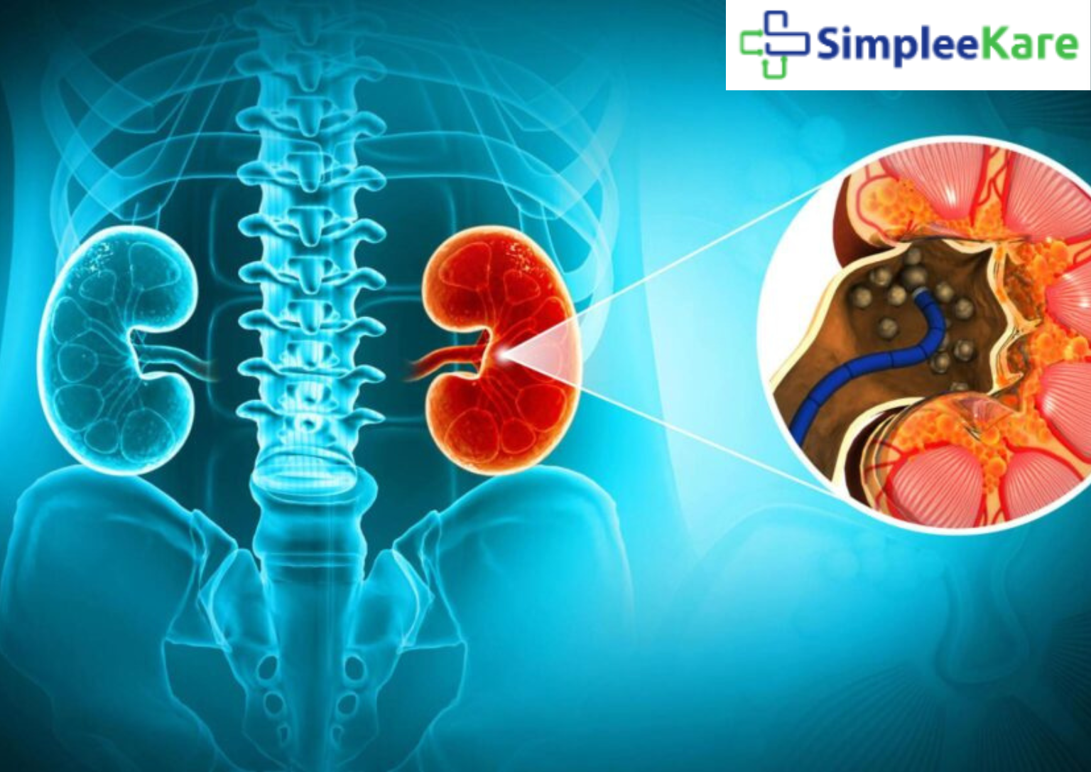 Painless Kidney Stone Removal Laser Surgery in Bhubaneswar