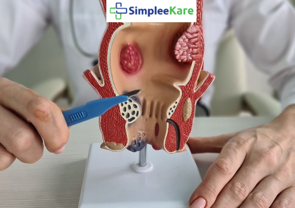 best piles surgery