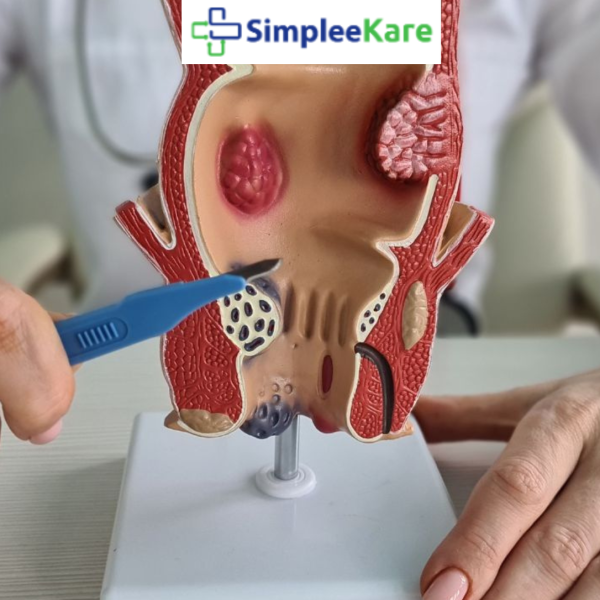 best piles surgery