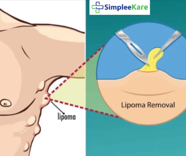 Why Choose SimpleeKare for the Best Lipoma Removal & Excision Surgery?